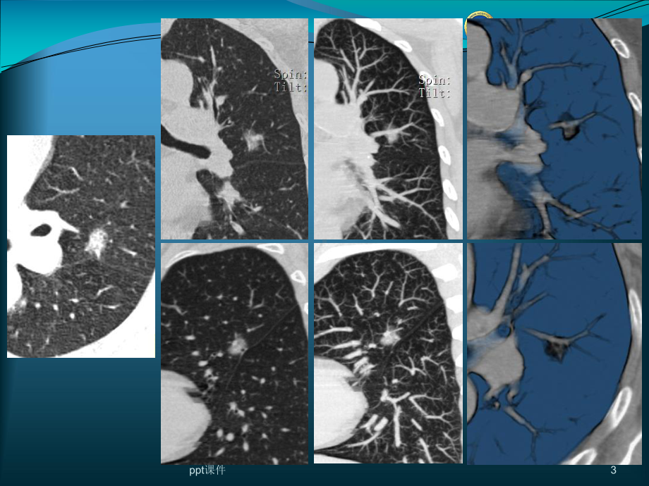 肺结节的检出与处理对策-ppt课件.ppt_第3页