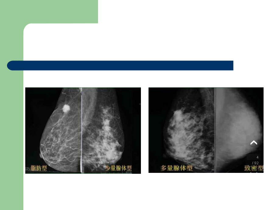 乳腺BIRADS分级课件.ppt_第3页