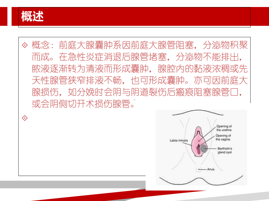 前庭大腺囊肿.ppt课件.ppt_第3页