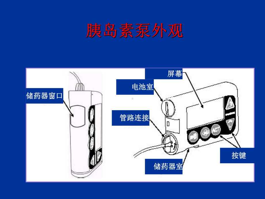 胰岛素泵治疗介绍ppt课件.ppt_第3页