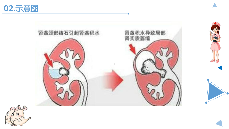 肾结核护理常规PPT课件.ppt_第3页