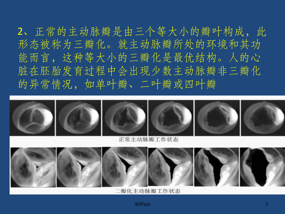 主动脉瓣狭窄(AS)课件.ppt_第3页