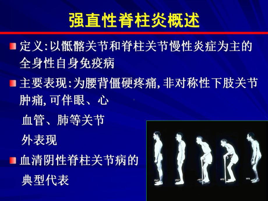 强直性脊柱炎的诊断和治疗PPT课件.ppt_第2页