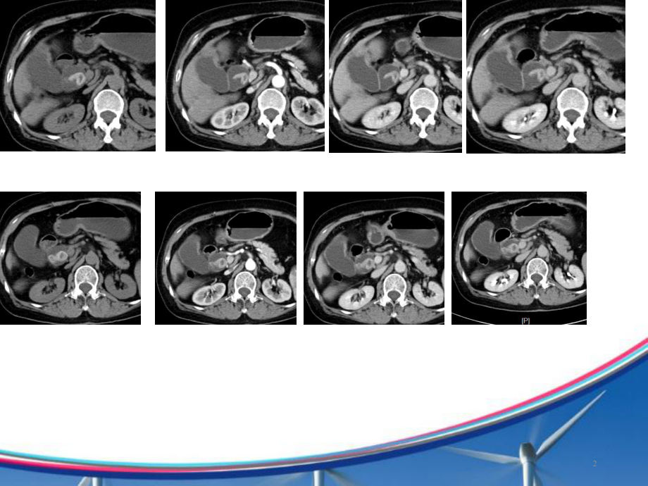 胆囊癌一例PPT课件.ppt_第2页