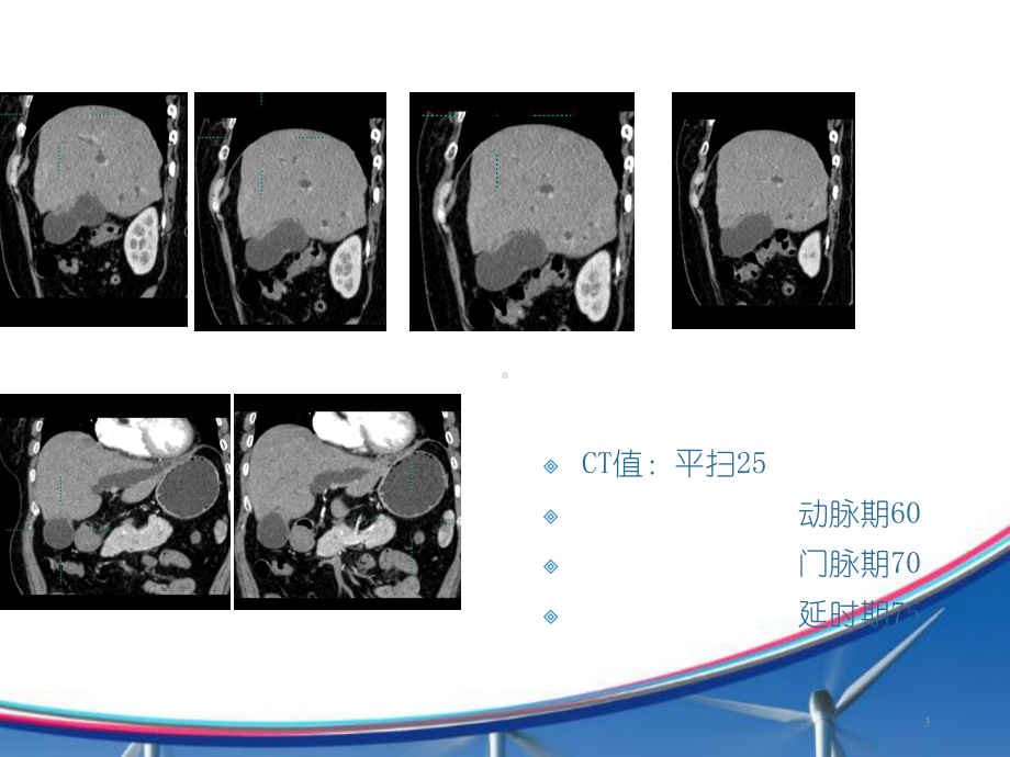 胆囊癌一例PPT课件.ppt_第3页