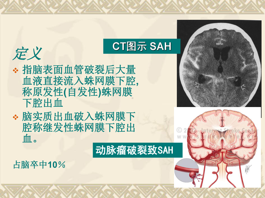 蛛网膜下腔出血定义ppt课件.ppt_第2页