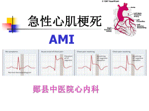 急性心肌梗死的诊治课件.ppt