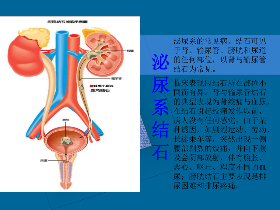 尿路结石与肾功能损害课件.ppt_第2页