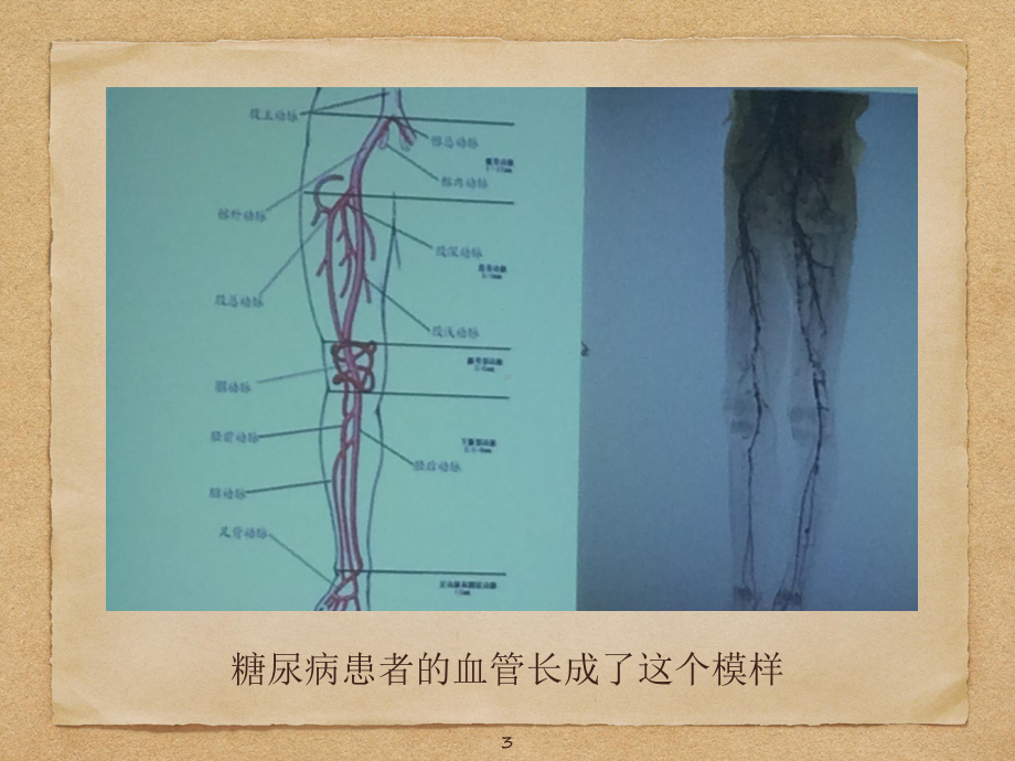 糖尿病患者的麻醉管理PPT课件.ppt_第3页