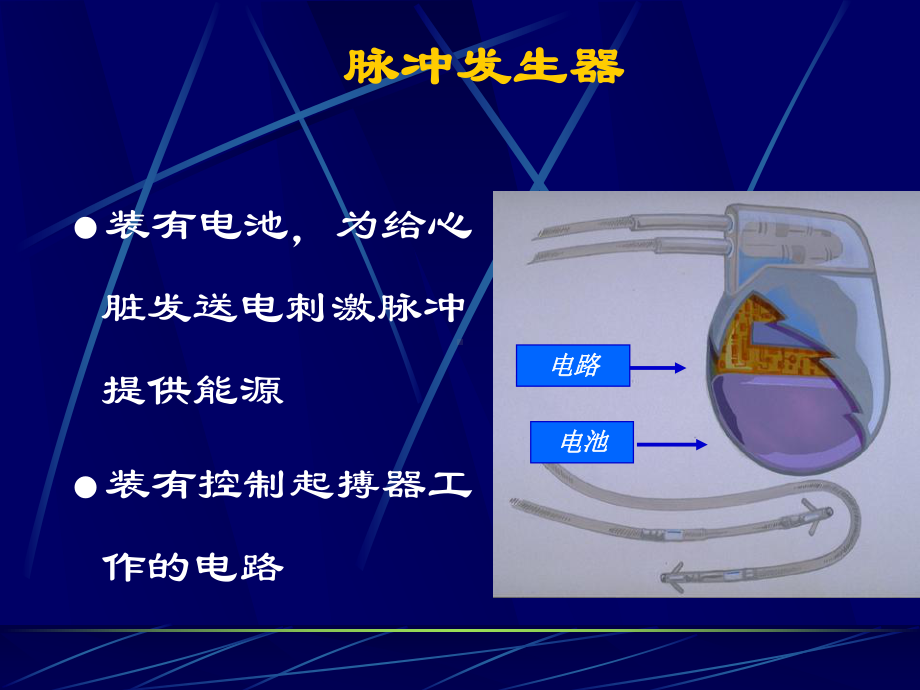 人工心脏起搏治疗的护理课件.ppt_第3页