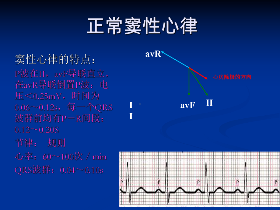 恶性心律失常的识别与护理PPT课件.ppt_第3页