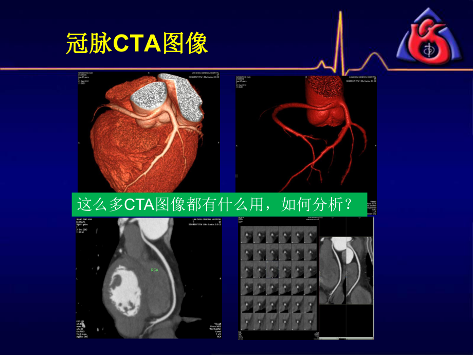 冠脉CTA读片非常课件.pptx_第3页