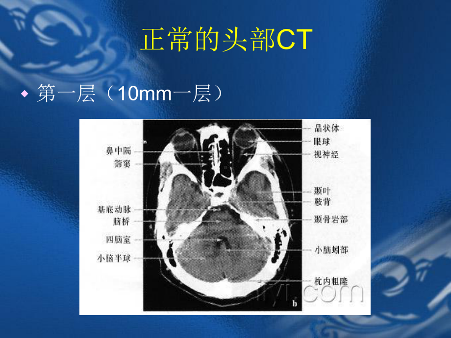 CT片的阅读技巧颅脑课件.ppt_第3页