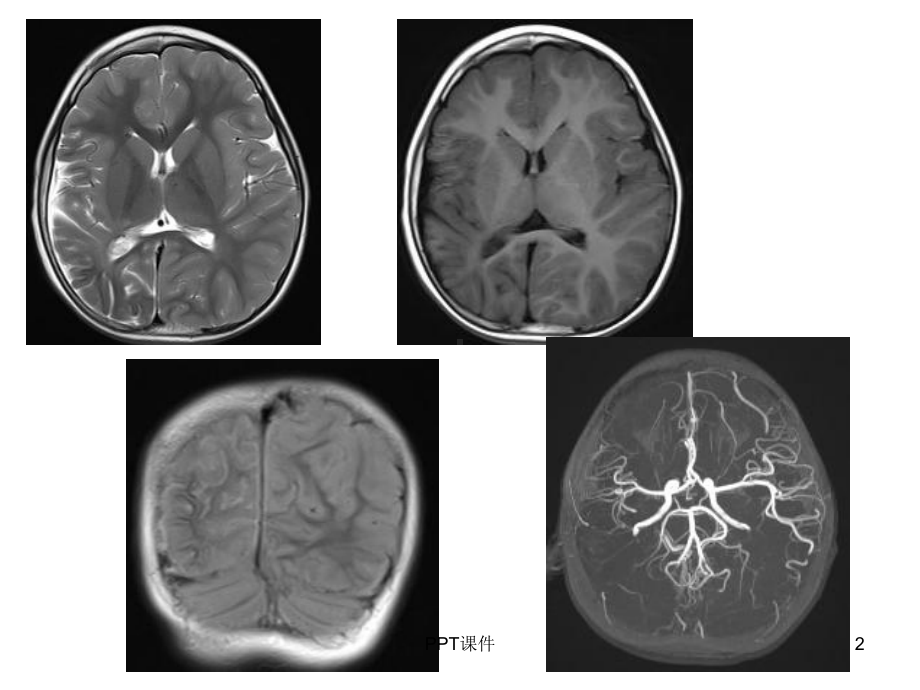 Sturge-weber综合征-ppt课件.ppt_第2页