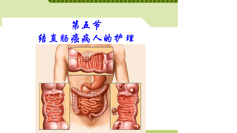 第五节结直肠癌病人护理课件.ppt_第2页