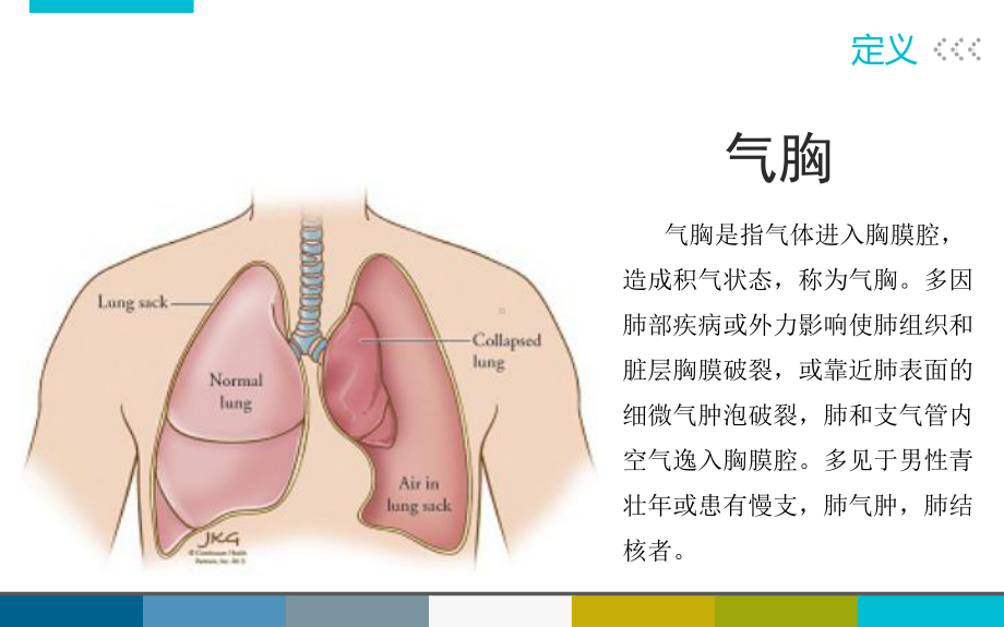 Ⅱ型呼衰合并气胸个案课件.ppt_第3页