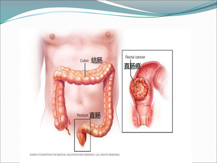 结直肠癌病理诊断规范课件.ppt_第2页