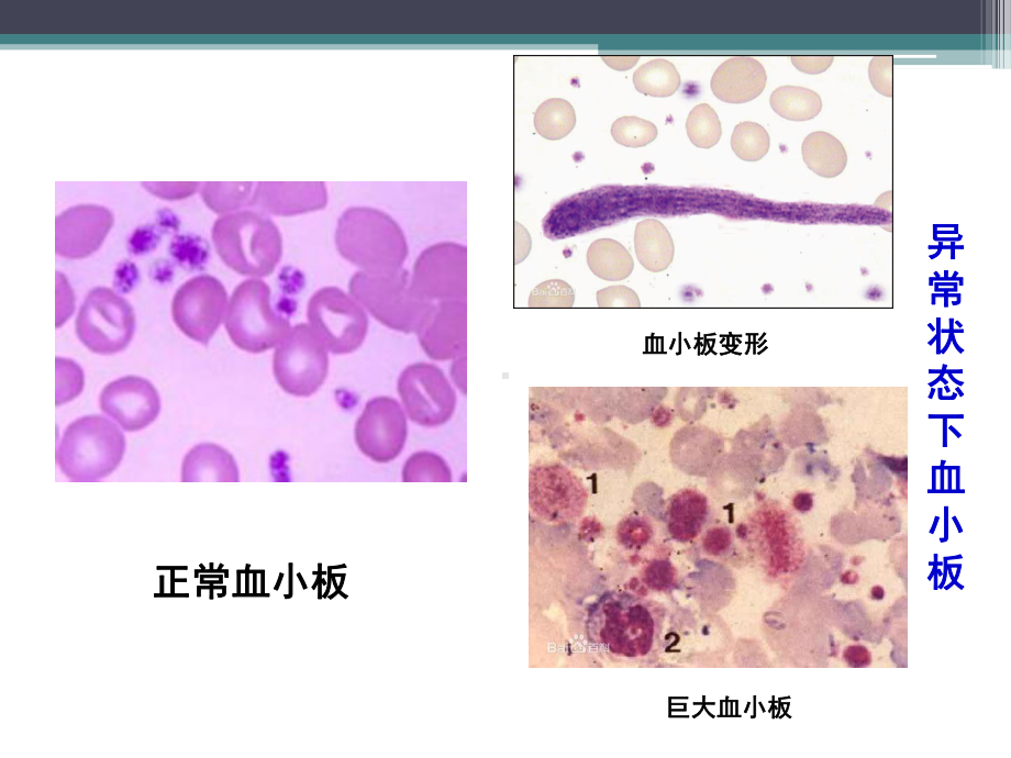 PCI术后血小板减少课件.pptx_第3页