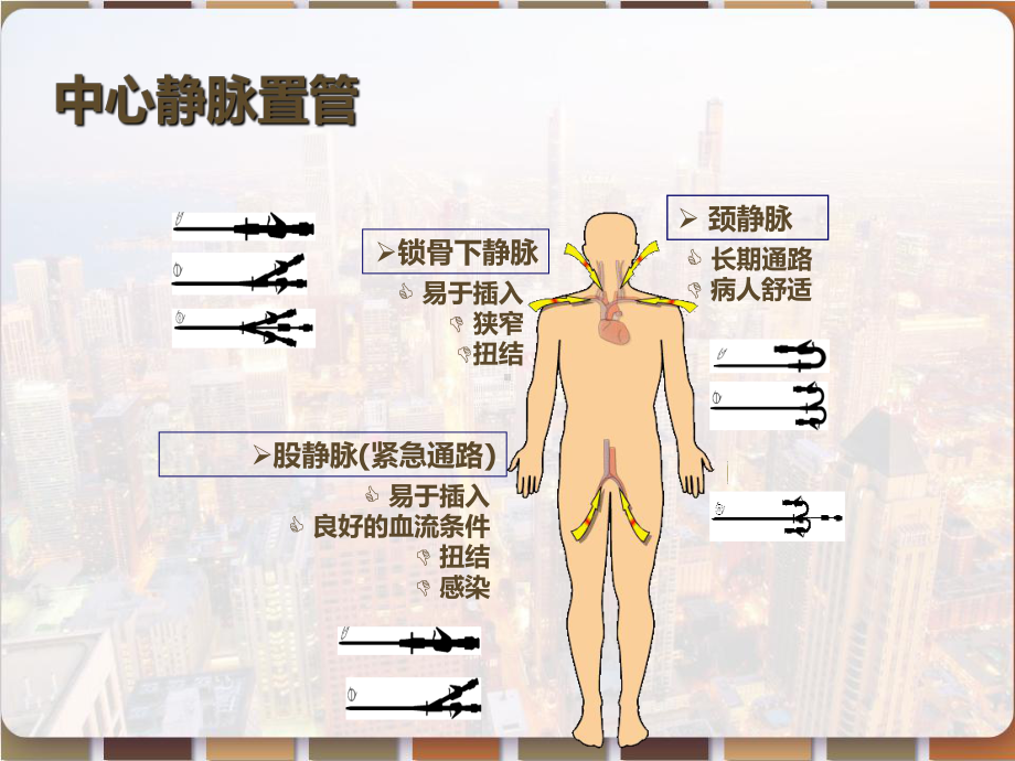 深静脉置管术-PPT课件.pptx_第2页