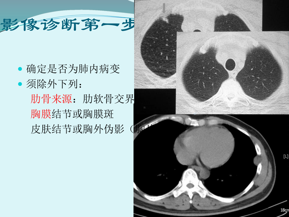 胸部CT肺内孤立性结节课件.ppt_第3页