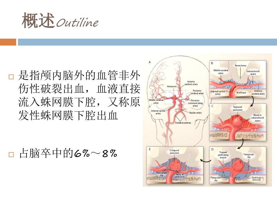 蛛网膜下腔出血的规范化诊治课件.ppt_第2页