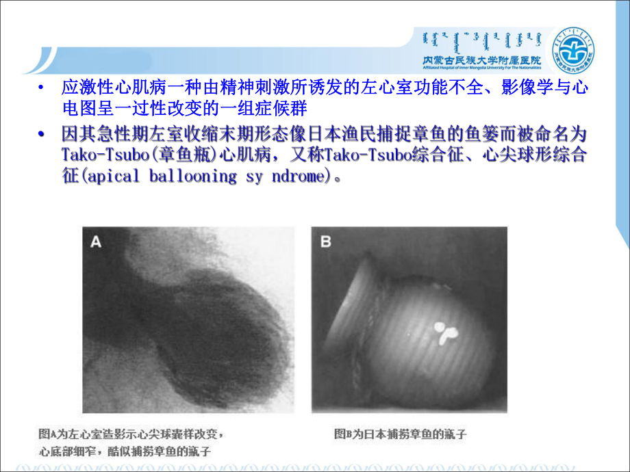 应激性心肌病最新版本课件.ppt_第2页