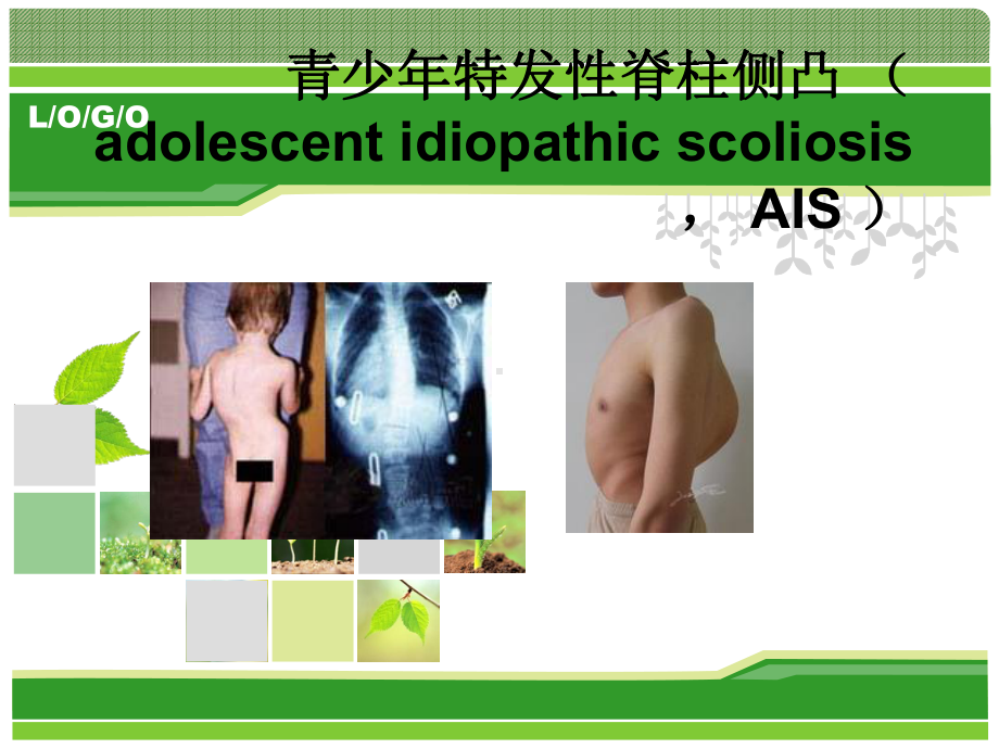 青少年特发性脊柱侧凸课件.ppt_第1页