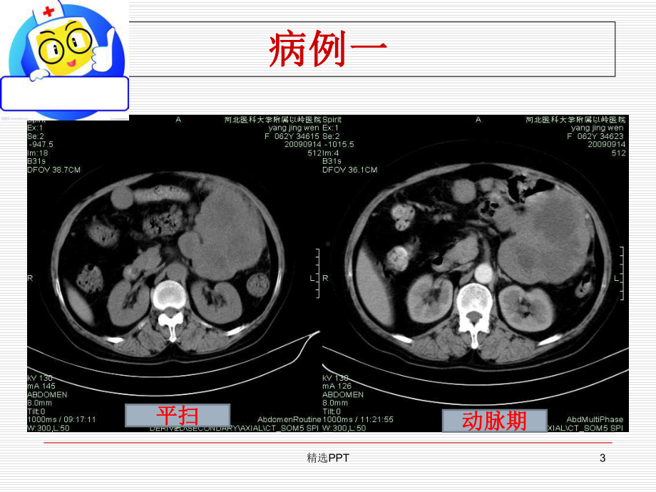 胃肠道间质瘤的影像诊断课件.ppt_第3页