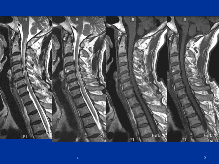 脊髓亚急性联合变性73317课件.ppt_第3页