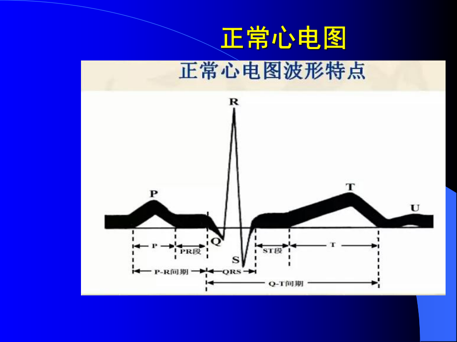 麻醉手术中常见心率失常课件.ppt_第3页