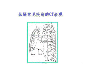 纵膈常见疾病的CT表现课件.ppt