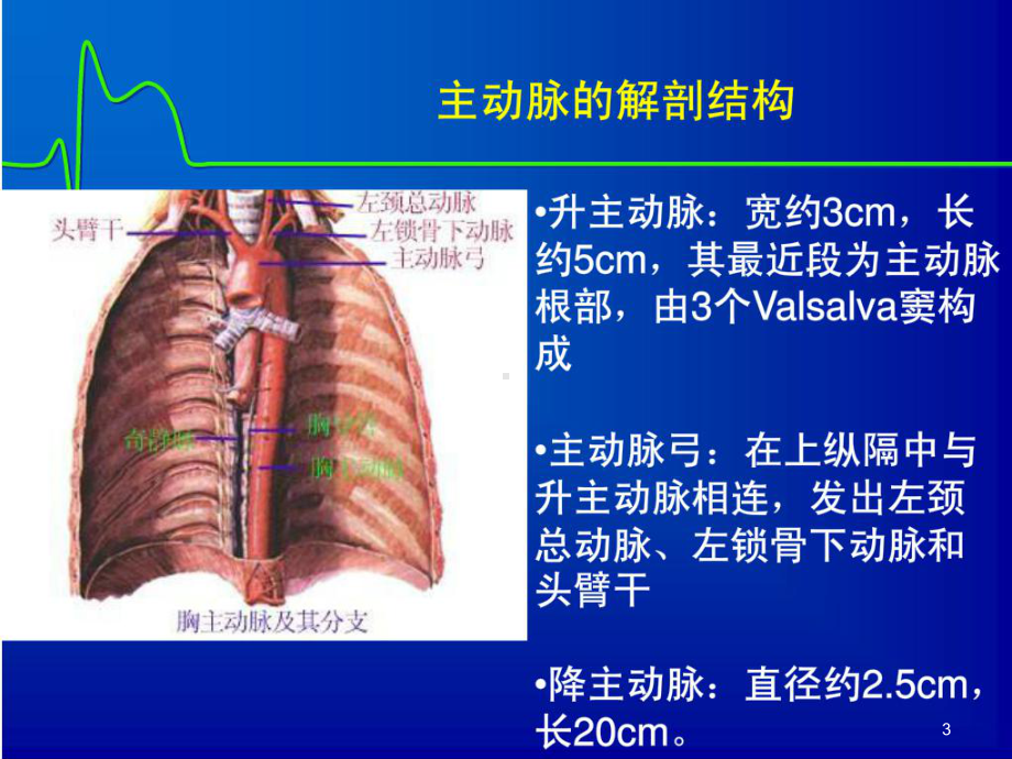 主动脉夹层PPT课件.ppt_第3页