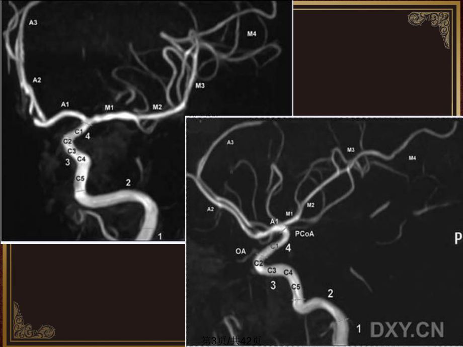 大脑中动脉课件.pptx_第3页