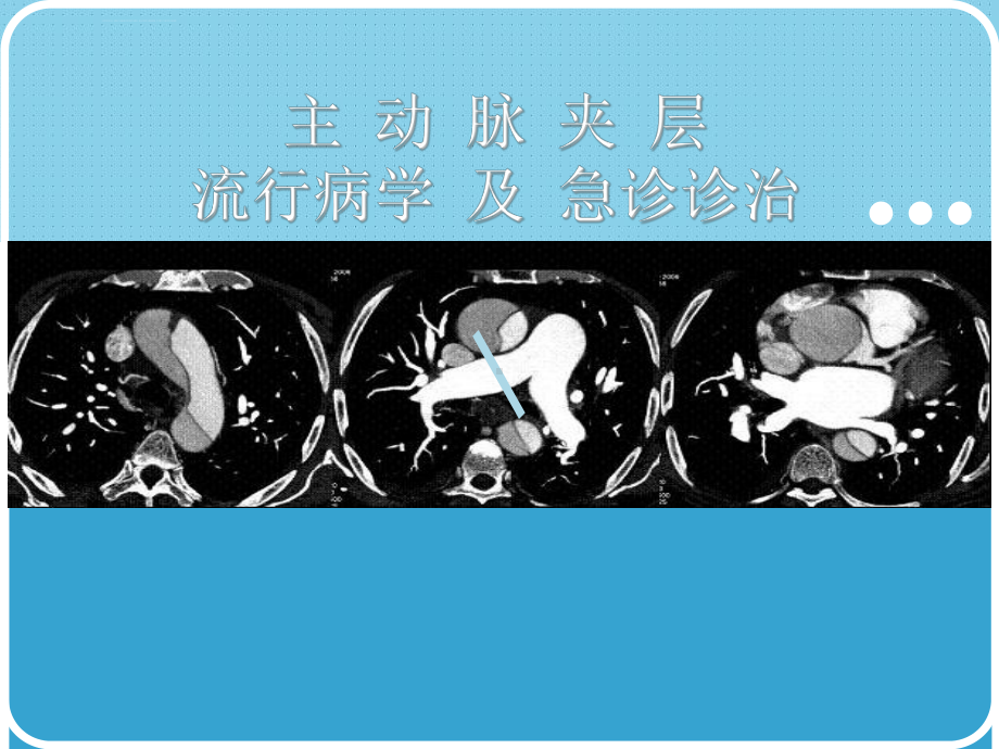 钱招昕主动脉夹层急诊诊治课件.ppt_第1页