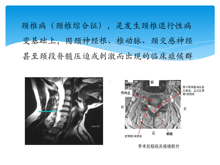 颈椎病预防保健知识课件.pptx_第3页