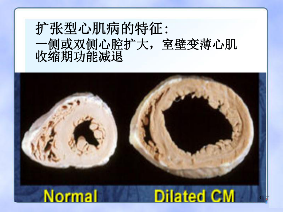 扩张型心肌病PPT课件.ppt_第3页