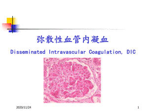 DIC的诊断及治疗-ppt课件.ppt