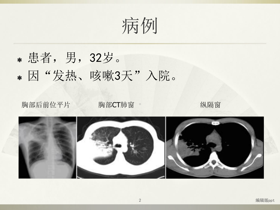 大叶性肺炎的影像诊断PPT课件.ppt_第2页