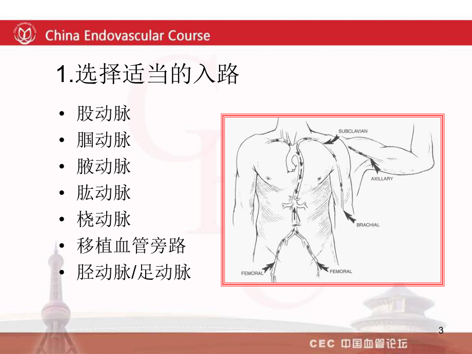 开通主髂动脉闭塞段病变的常用技术吴丹明PPT课件.ppt_第3页