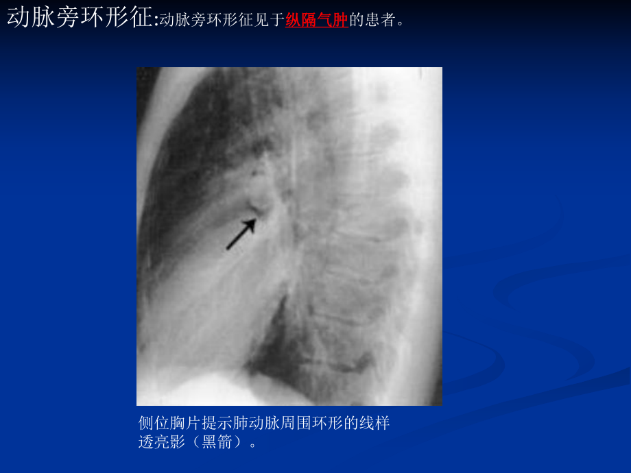 特殊征象的X线诊断.课件.ppt_第2页