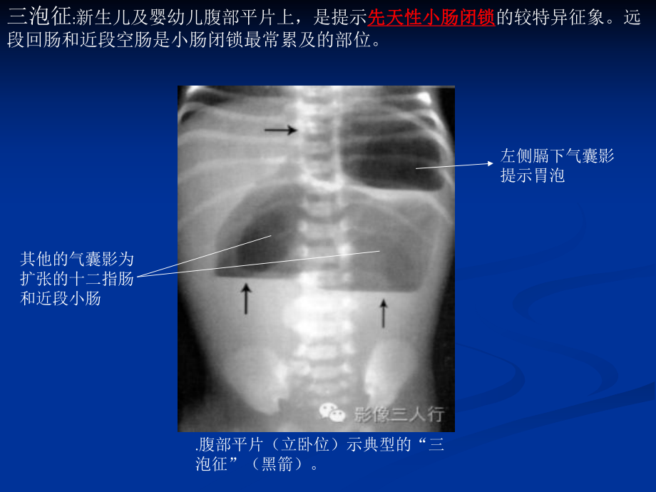 特殊征象的X线诊断.课件.ppt_第3页