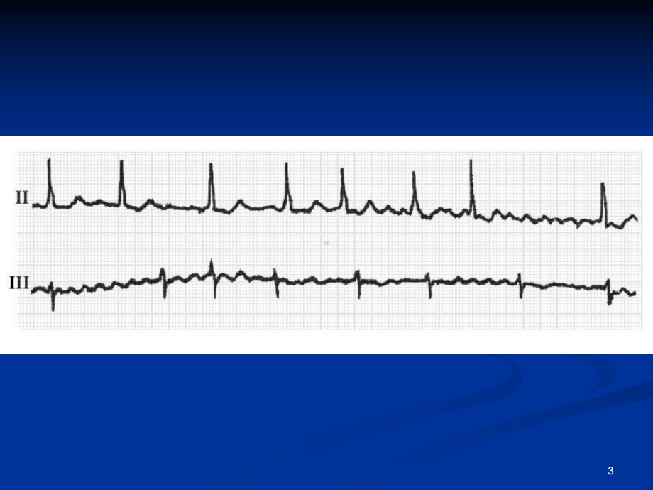 房颤的心电图诊断ppt课件.ppt_第3页