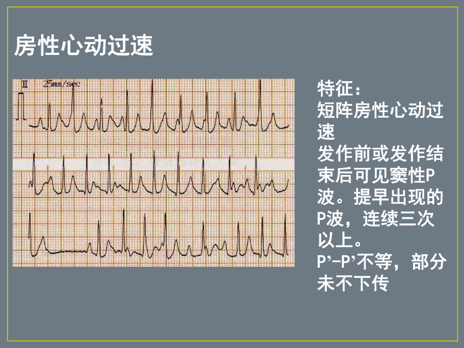 最新房性心动过速主题讲座课件.ppt_第2页