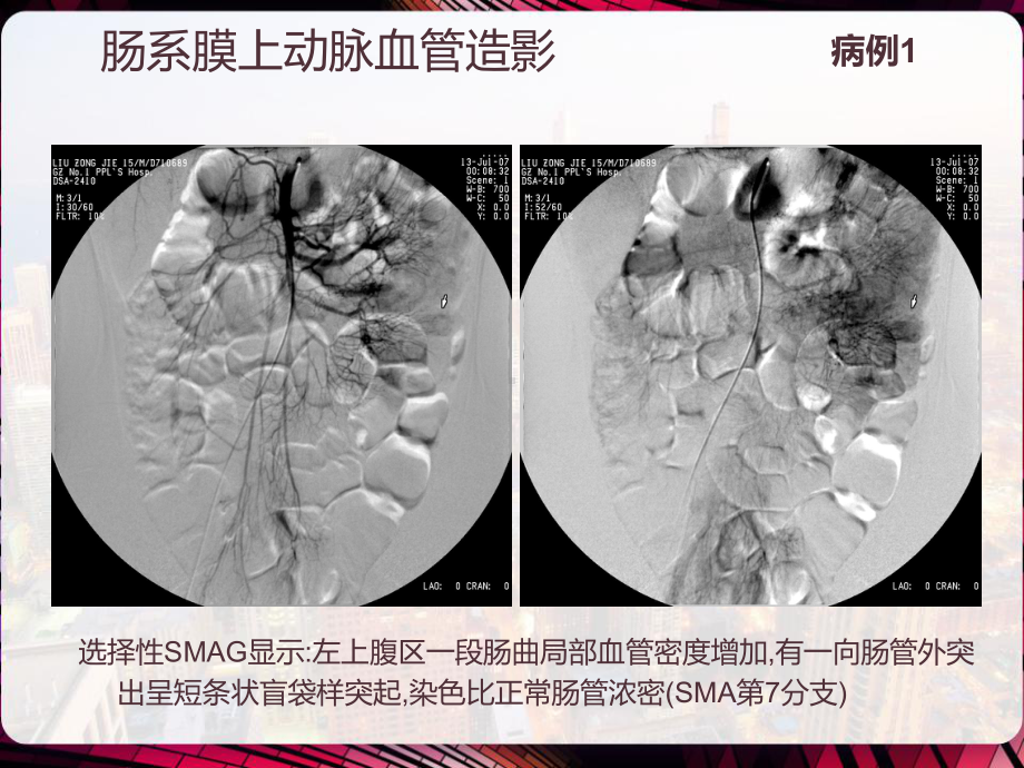 麦克尔憩室的影像学诊断-PPT课件.pptx_第3页