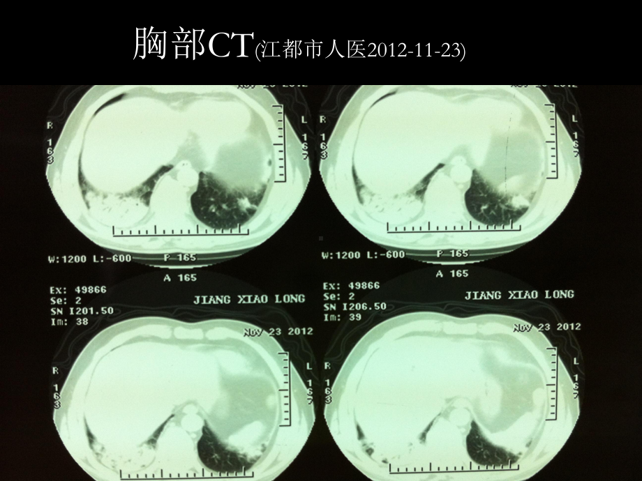 最新急性纤维素性机化性肺炎病例学习主题讲座课件.ppt_第3页