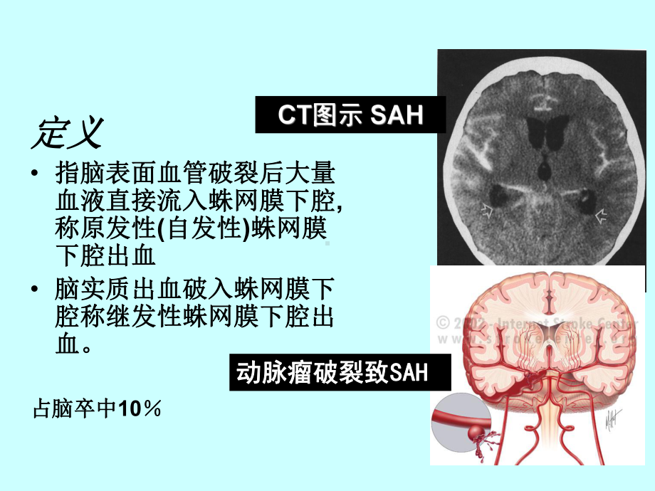 蛛网膜下腔出血诊治流程课件.ppt_第2页