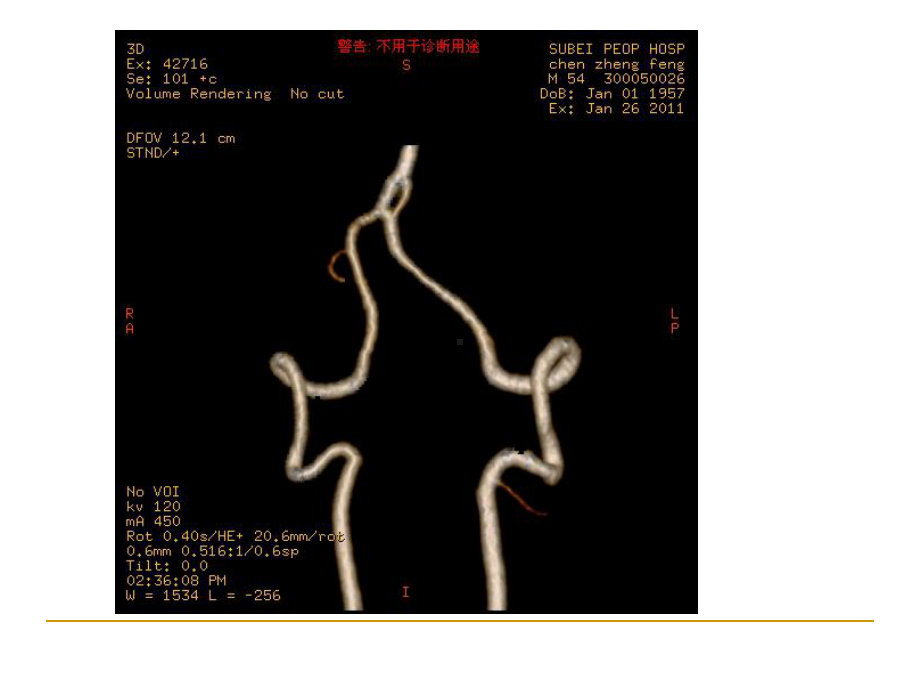 最新头颈部动脉开窗畸形主题讲座课件.ppt_第2页