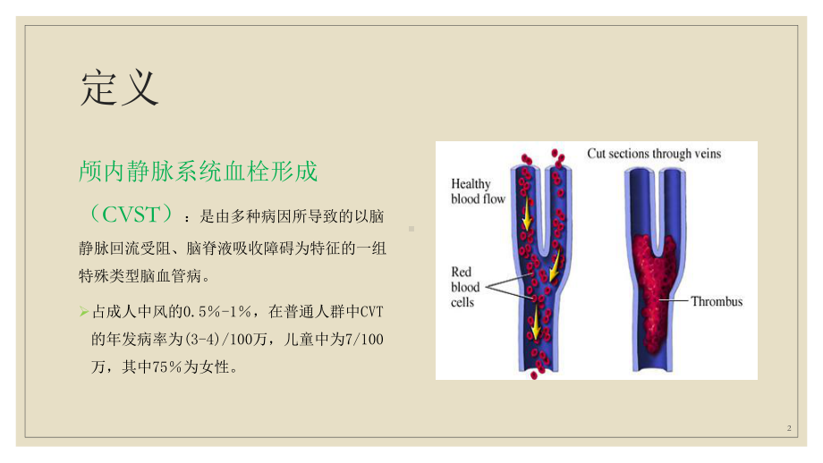 颅内静脉窦血栓ppt课件.pptx_第2页