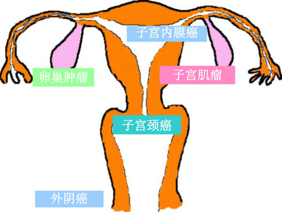 生殖系统肿瘤患者的护理课件.ppt_第3页