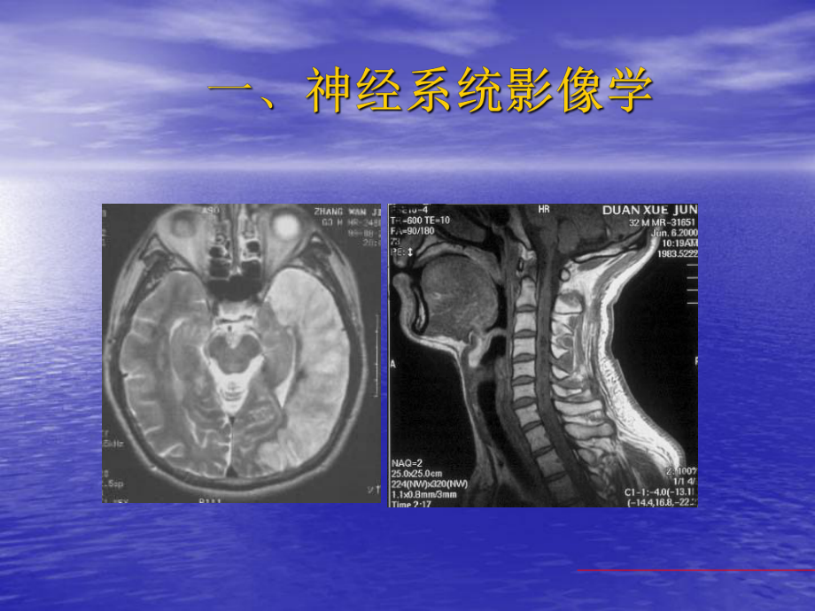 康复科主要影像学阅片课件.ppt_第2页